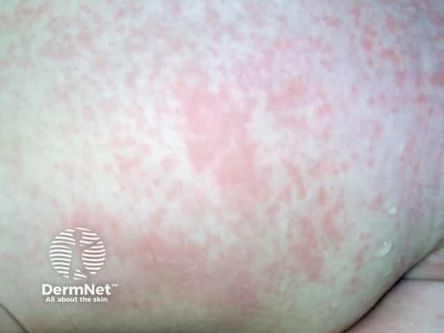 Gambar 1: Rubella. Credit: Freepik